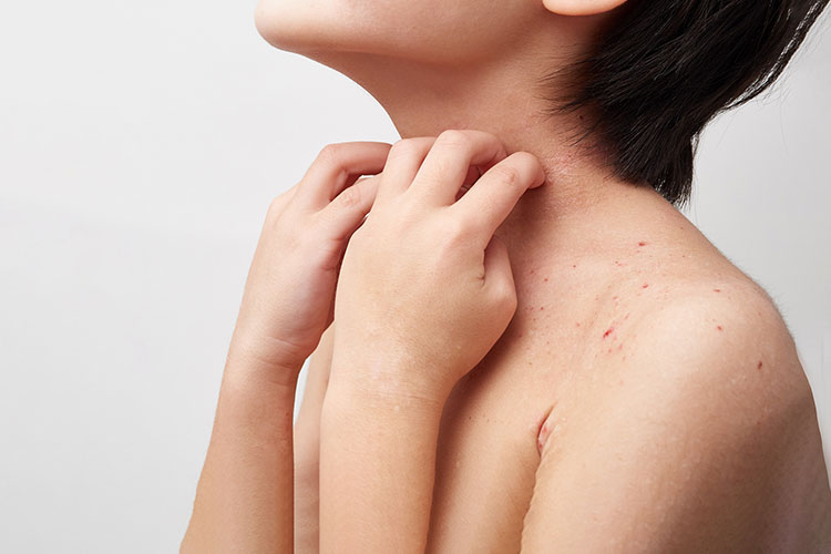 アトピー性皮膚炎